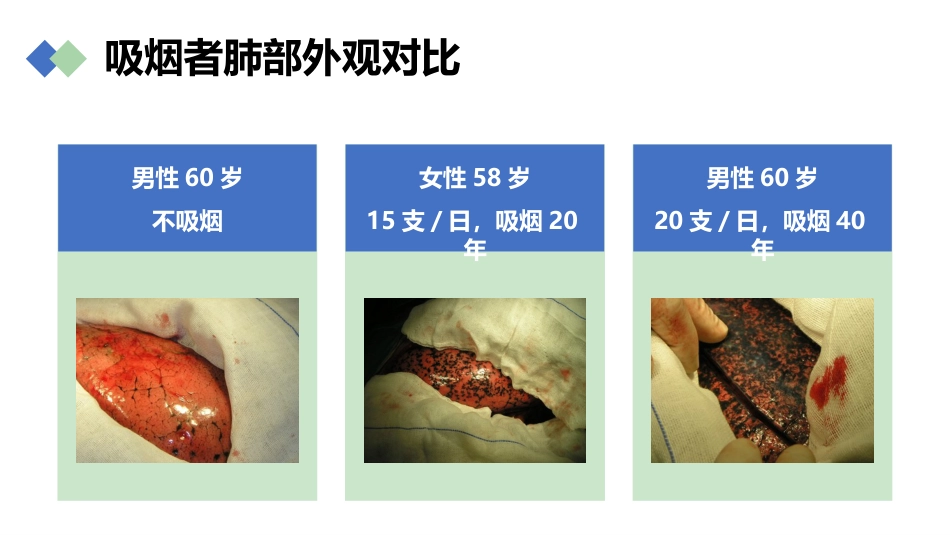 肺癌的早期诊断与防治_第9页