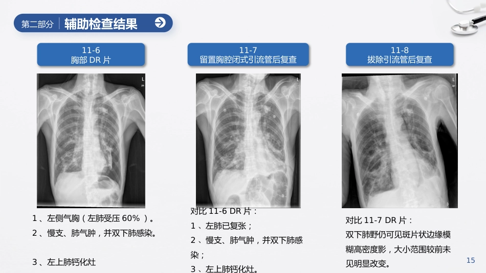延续护理模式对一例COPD患者的护理_第15页