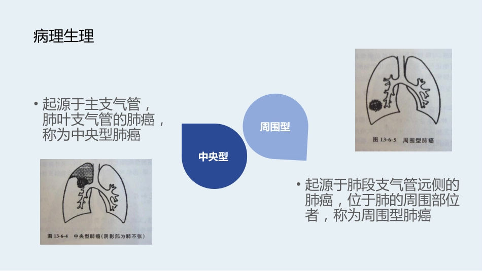 肺癌术前术后的护理_第10页