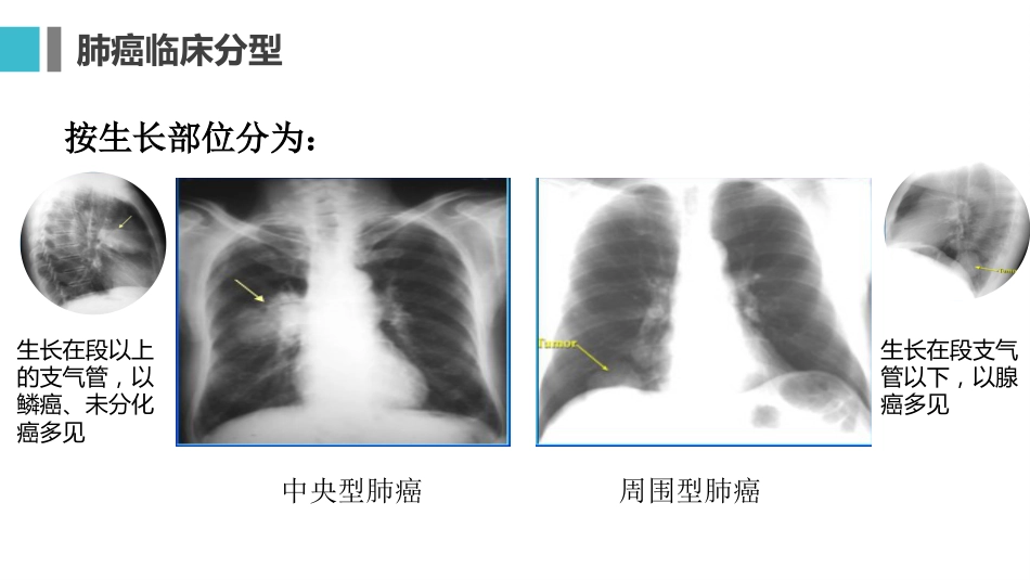 原发性支气管肺癌1_第13页