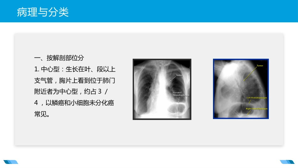 原发性支气管肺癌2_第13页
