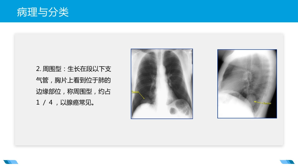 原发性支气管肺癌2_第14页