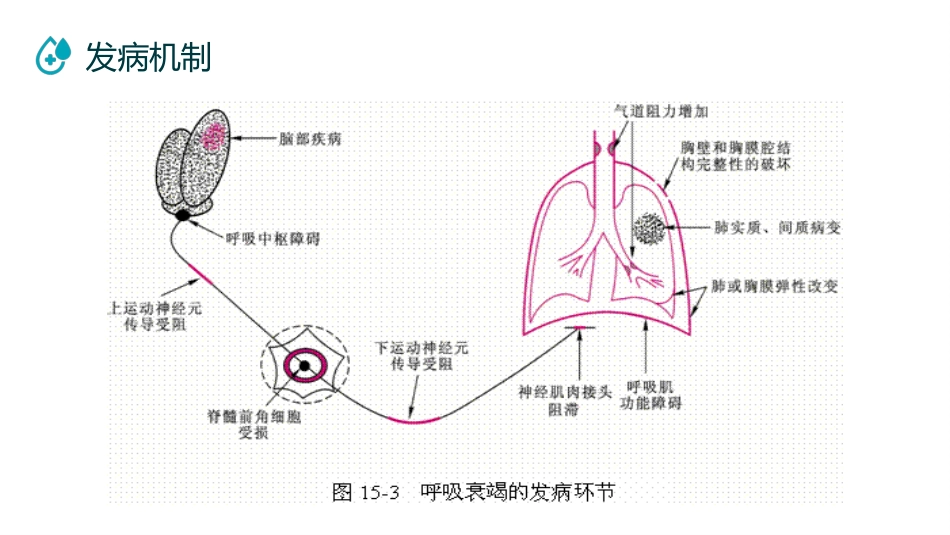 呼吸衰竭病人护理查房6_第14页