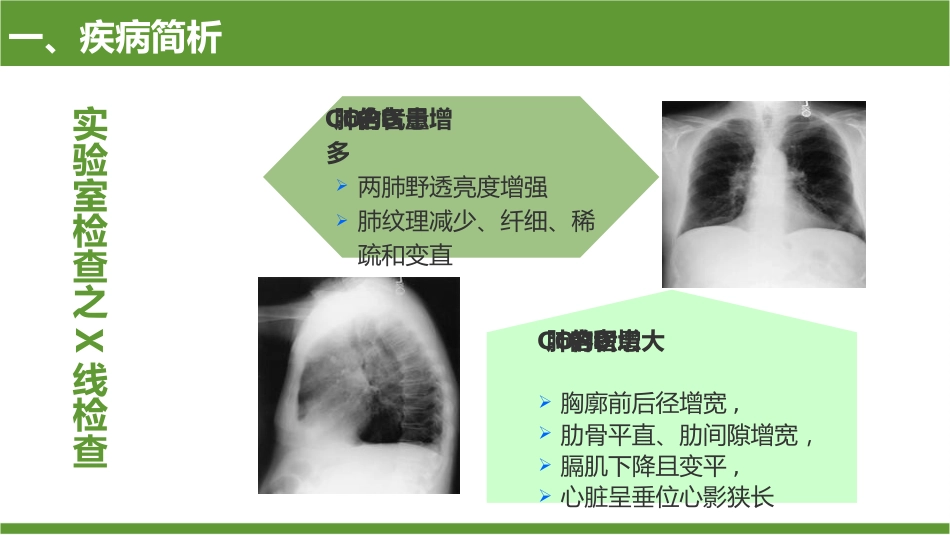 COPD患者护理查房9_第13页