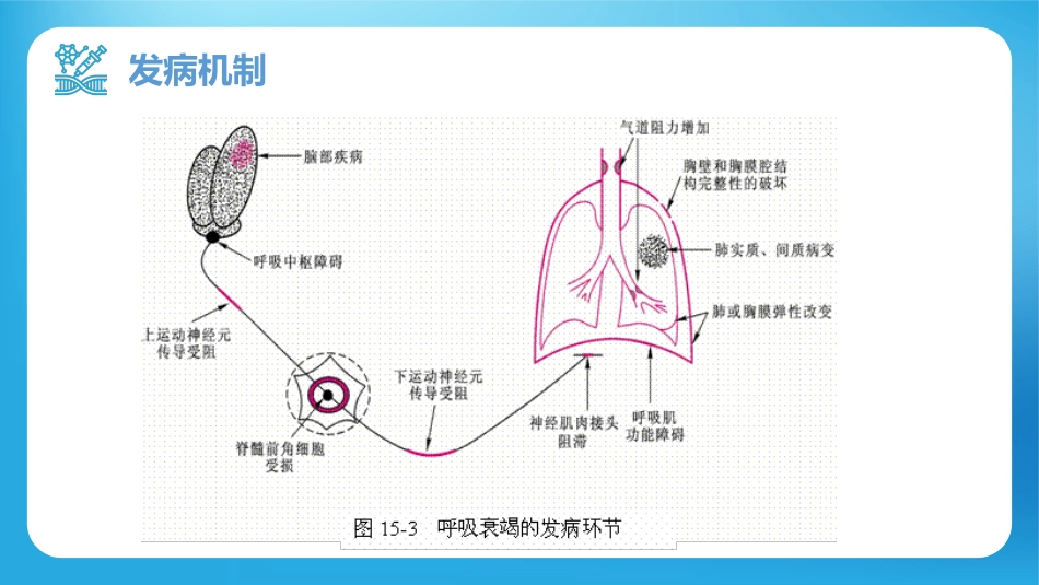 呼吸衰竭病人护理查房10_第14页