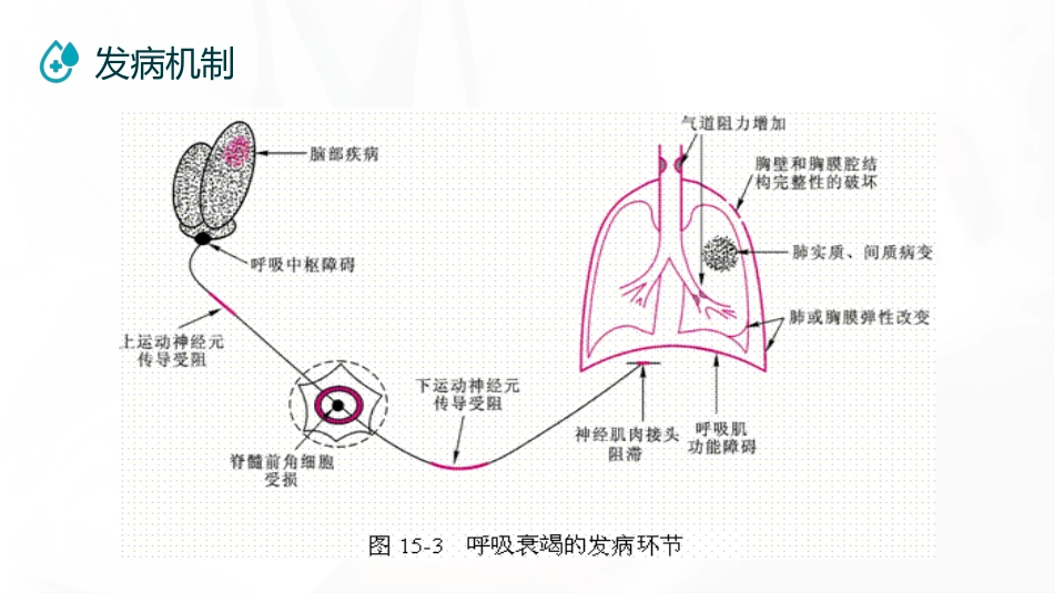 呼吸衰竭病人护理查房11_第14页