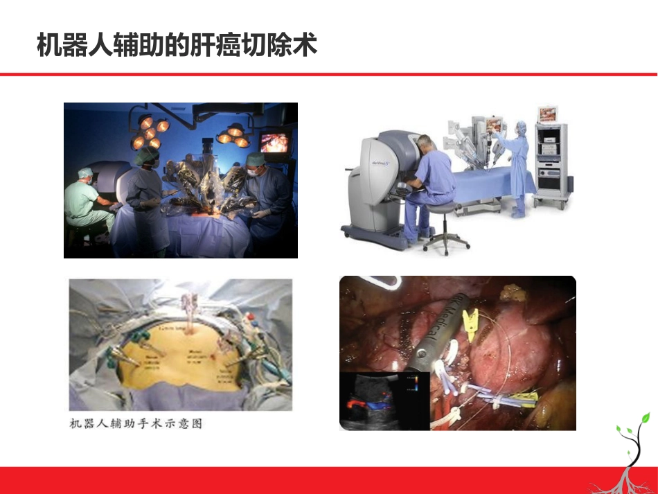 肝癌微创治疗简论_第12页