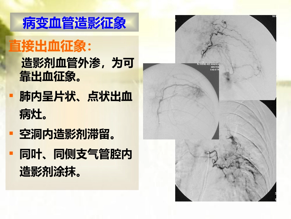 肺结核咯血的介入治疗 PPT_第10页