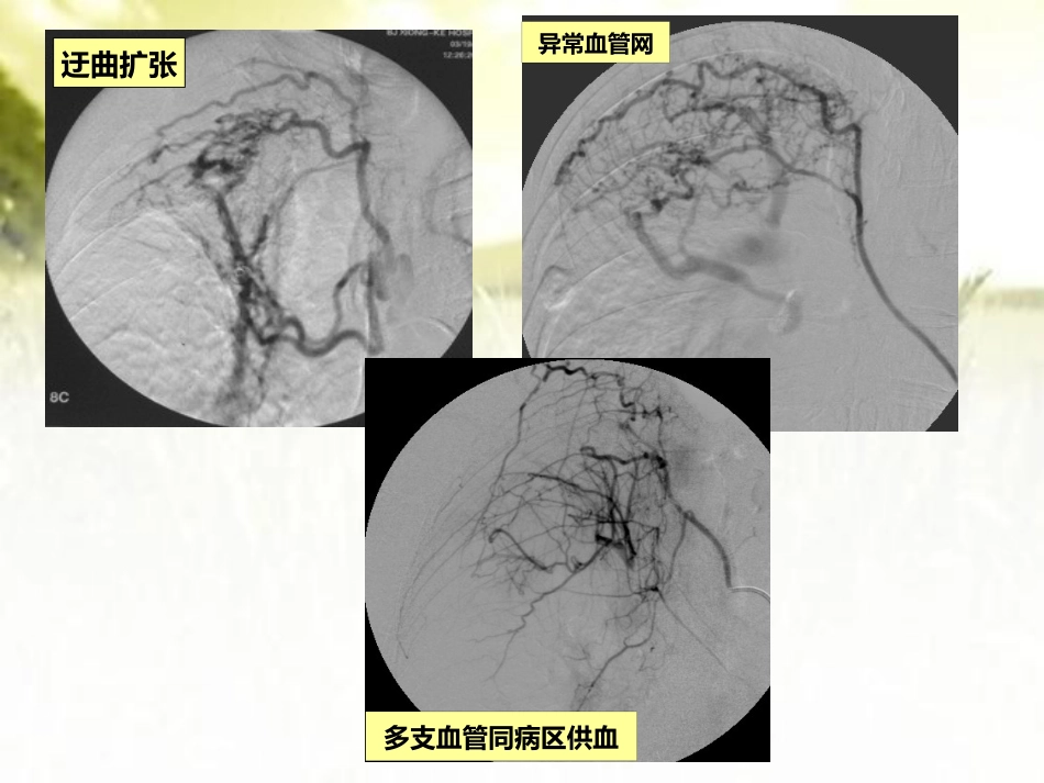 肺结核咯血的介入治疗 PPT_第12页