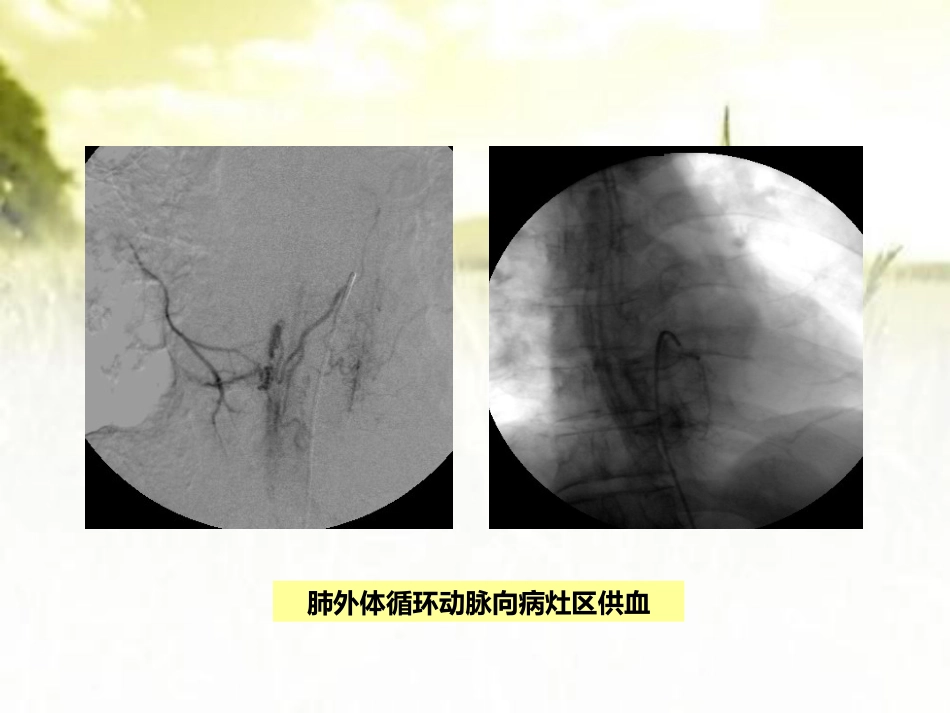 肺结核咯血的介入治疗 PPT_第14页