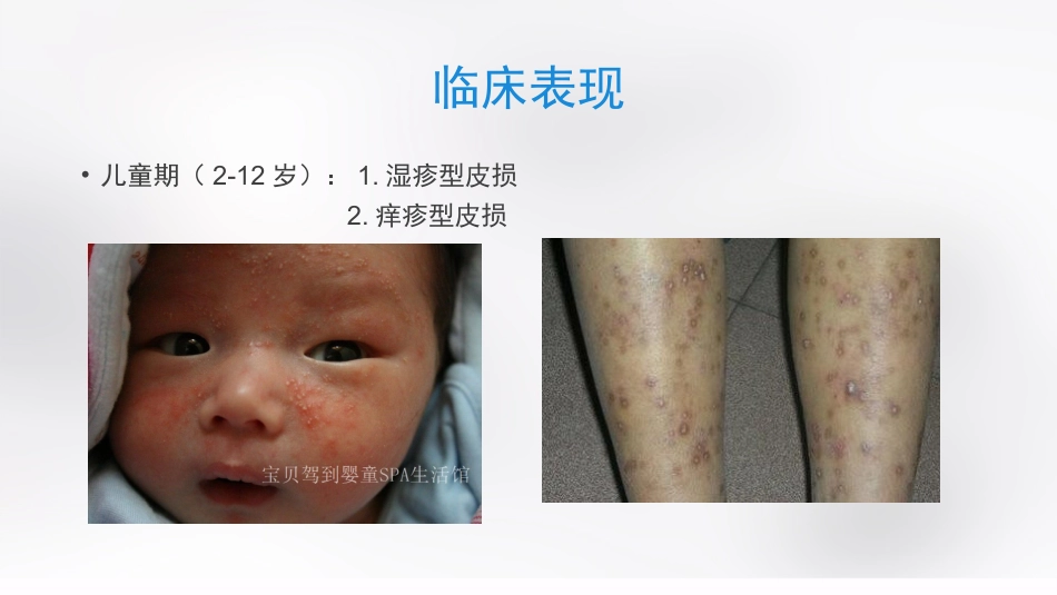 变态反应性皮肤病_第7页