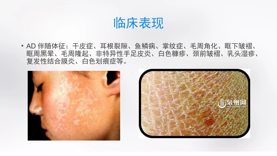 变态反应性皮肤病_第9页