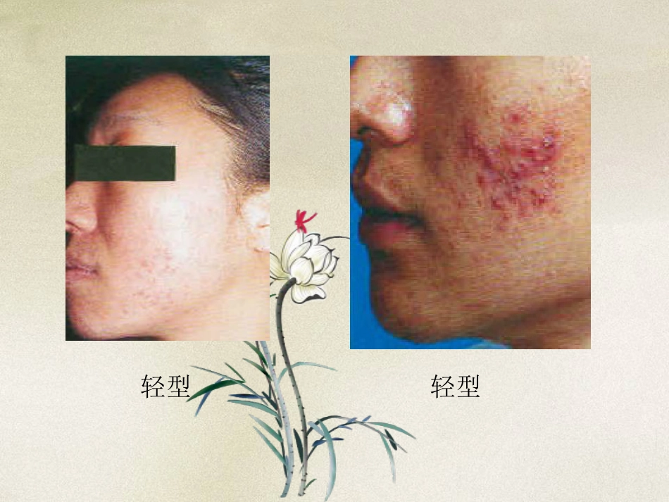 ppt痤疮l解析_第10页