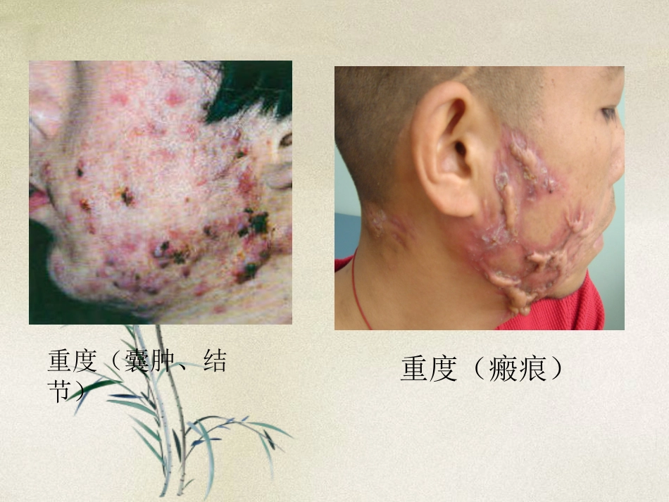 ppt痤疮l解析_第11页