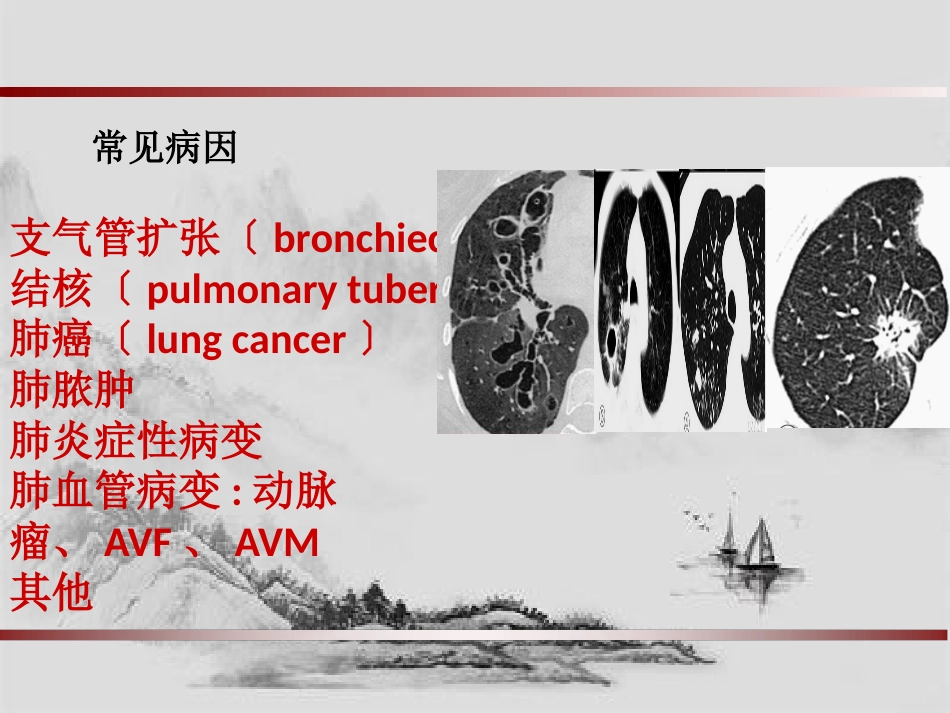 大咯血的介入治疗_第2页