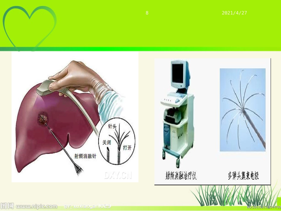 肝癌射频治疗_第8页