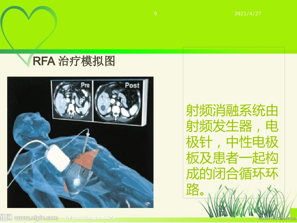 肝癌射频治疗_第9页