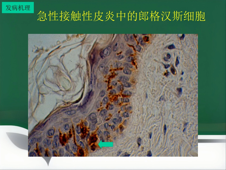 变态反应皮肤病ppt课件_第14页