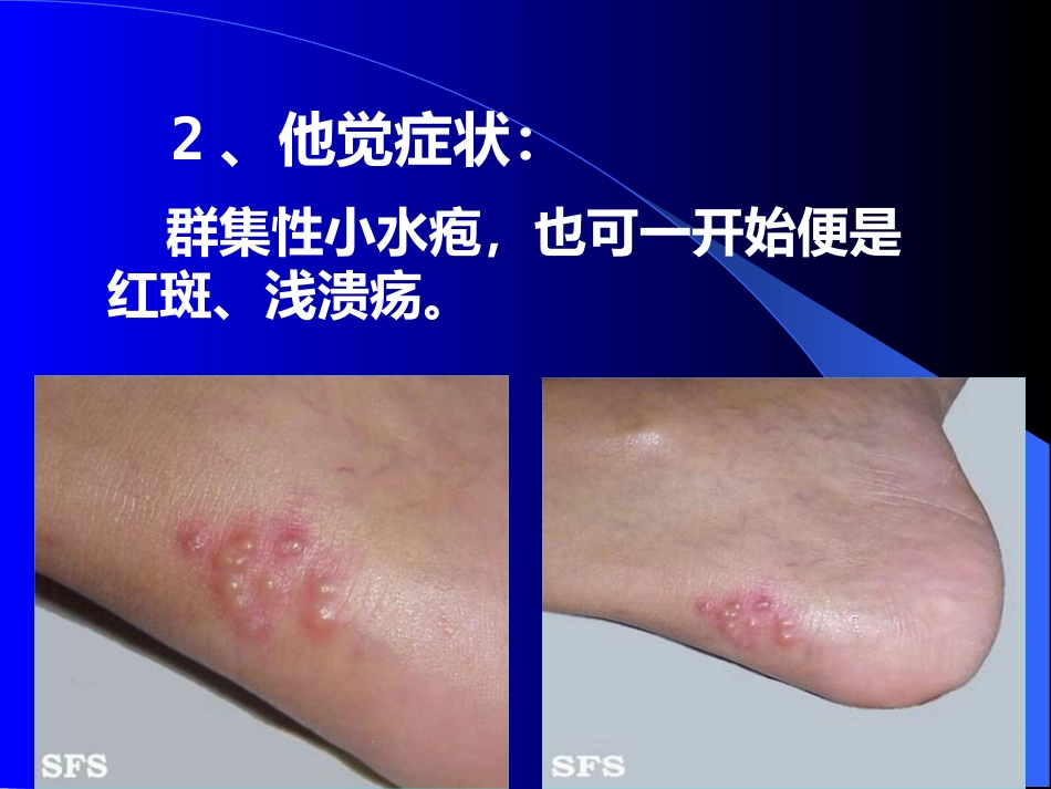 病毒性皮肤病_第11页