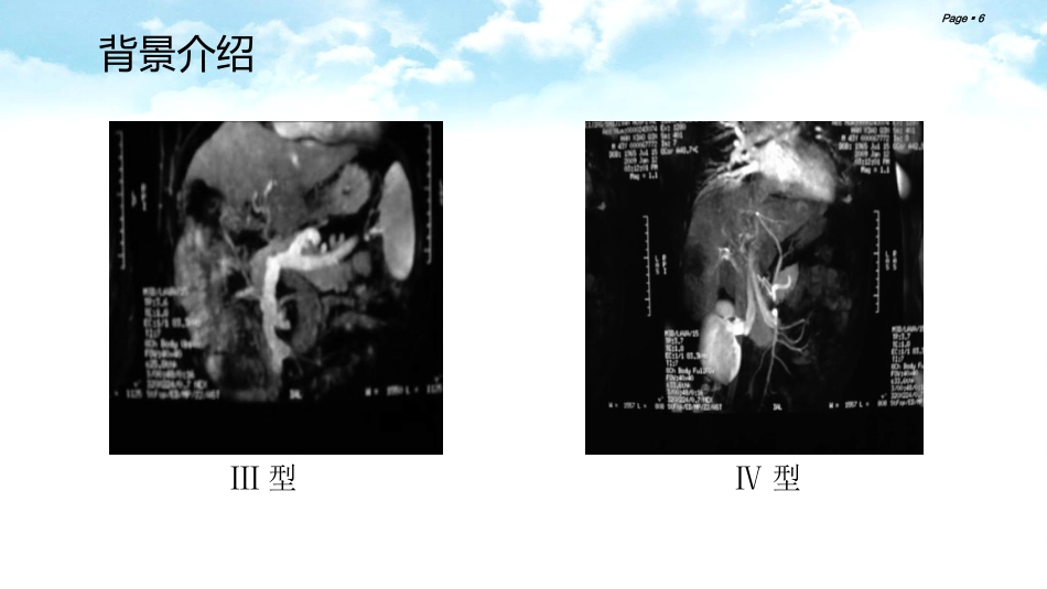 肝癌合并门静脉癌栓的综合治疗_第6页
