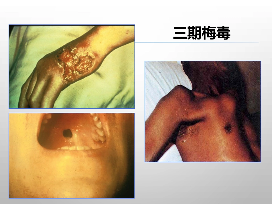 报告性病诊断标准_第13页