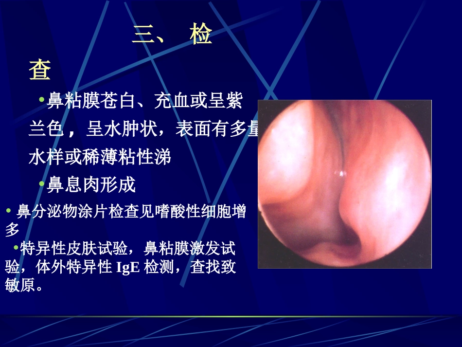 变应性过敏性鼻炎_第13页