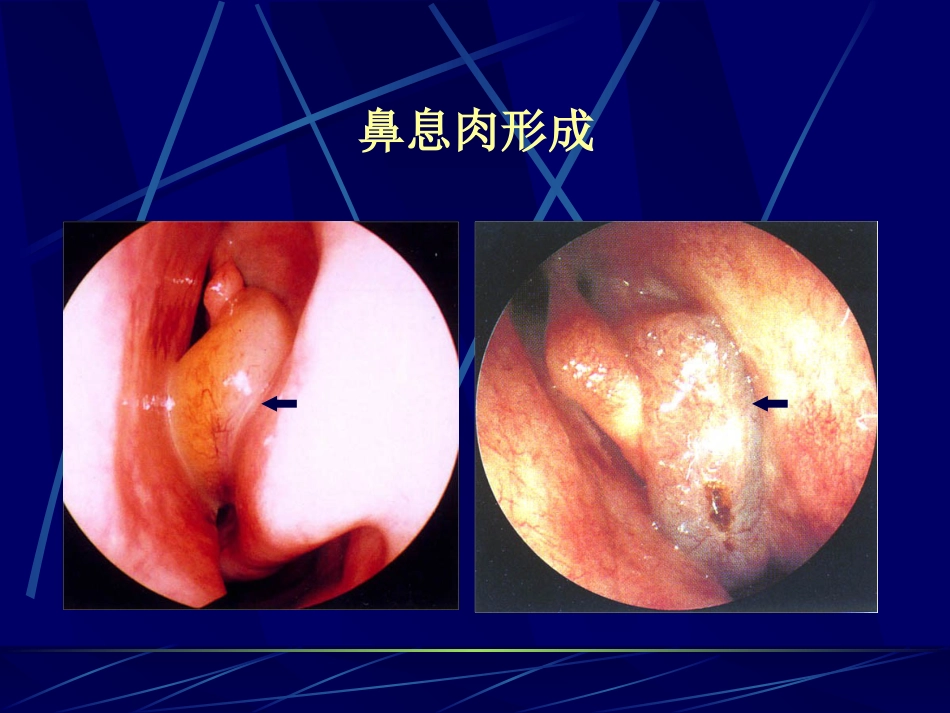 变应性过敏性鼻炎_第14页