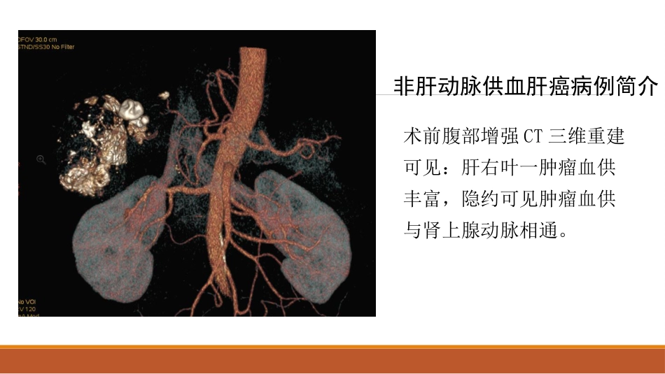 肝癌微创治疗 肝动脉化疗栓塞术(tace)_第13页