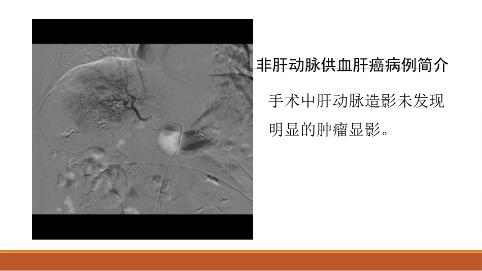 肝癌微创治疗 肝动脉化疗栓塞术(tace)_第14页