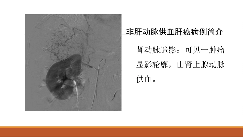 肝癌微创治疗 肝动脉化疗栓塞术(tace)_第15页