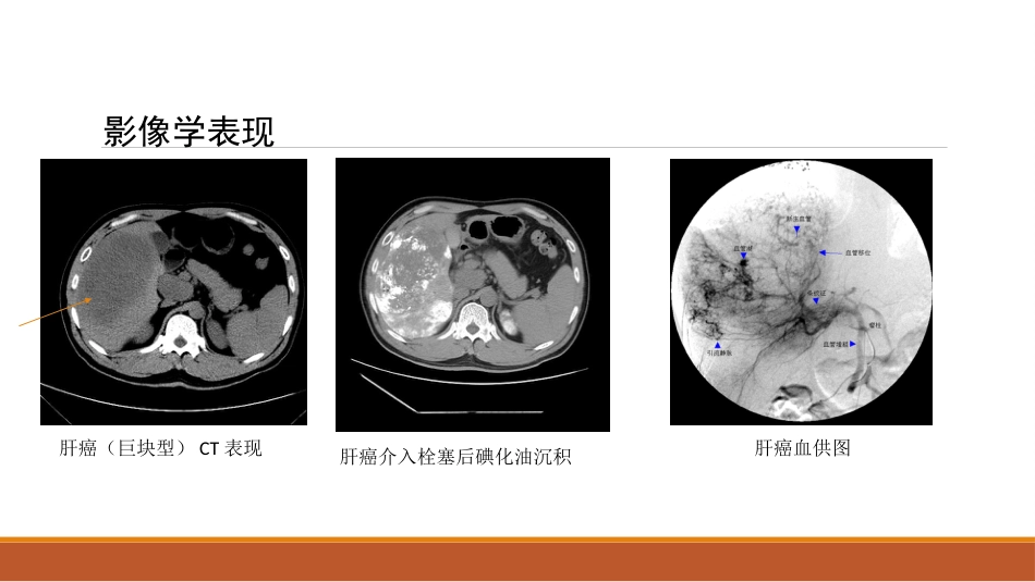 肝癌微创治疗 肝动脉化疗栓塞术(tace)_第8页