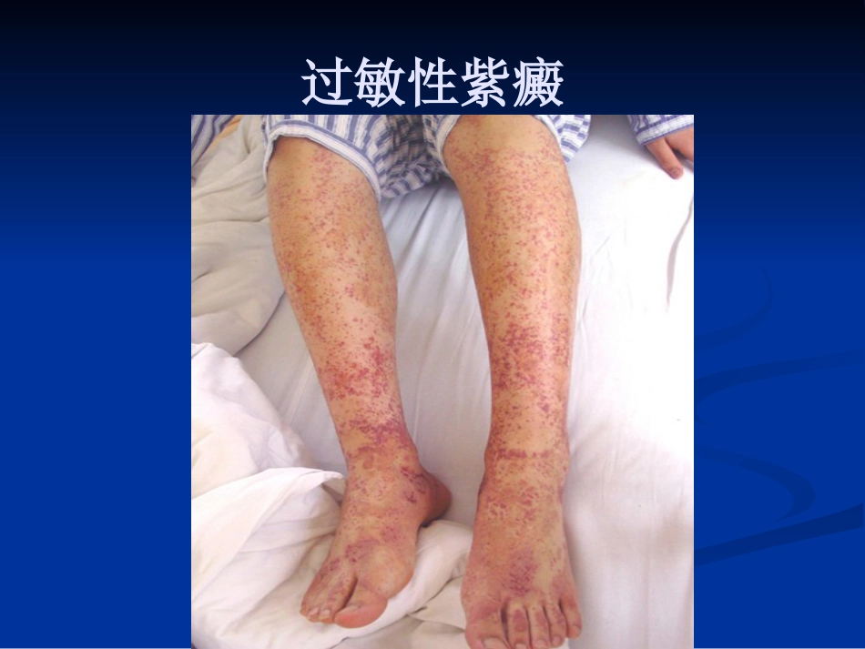 白碎血管炎(太原)_第4页