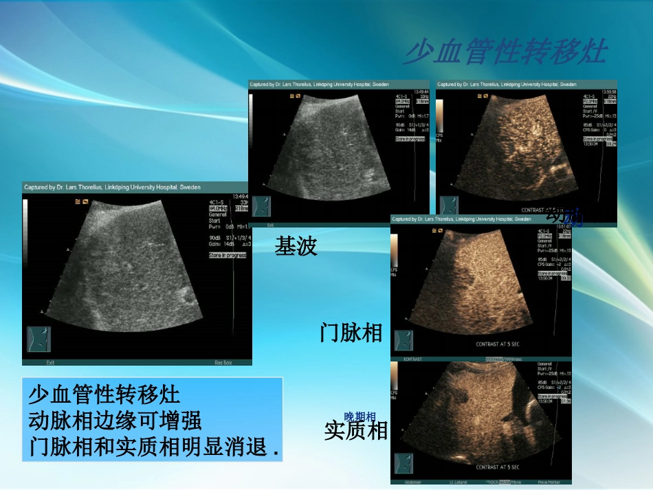 肝癌超声造影_第10页