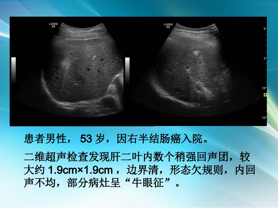 肝癌超声造影_第12页