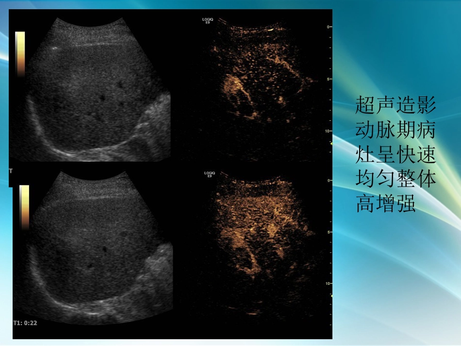 肝癌超声造影_第13页