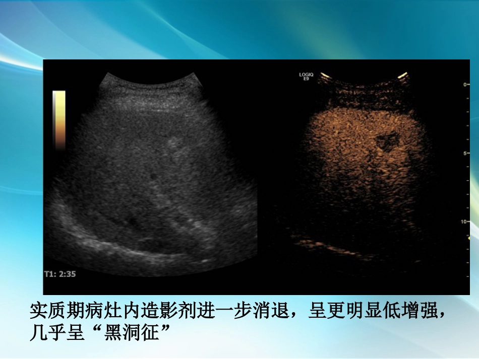 肝癌超声造影_第15页