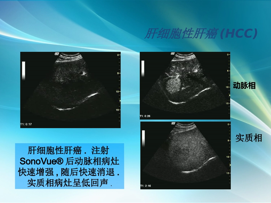 肝癌超声造影_第5页