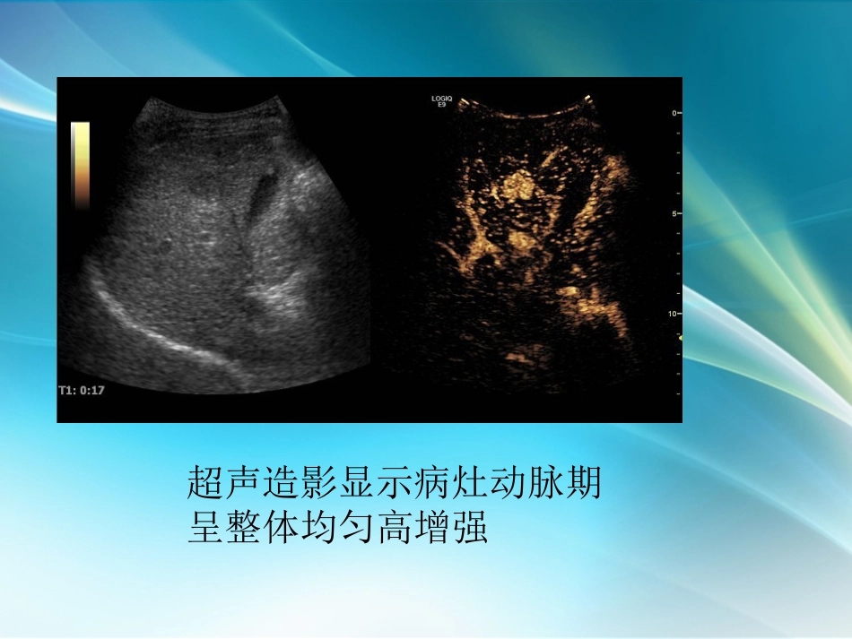 肝癌超声造影_第7页
