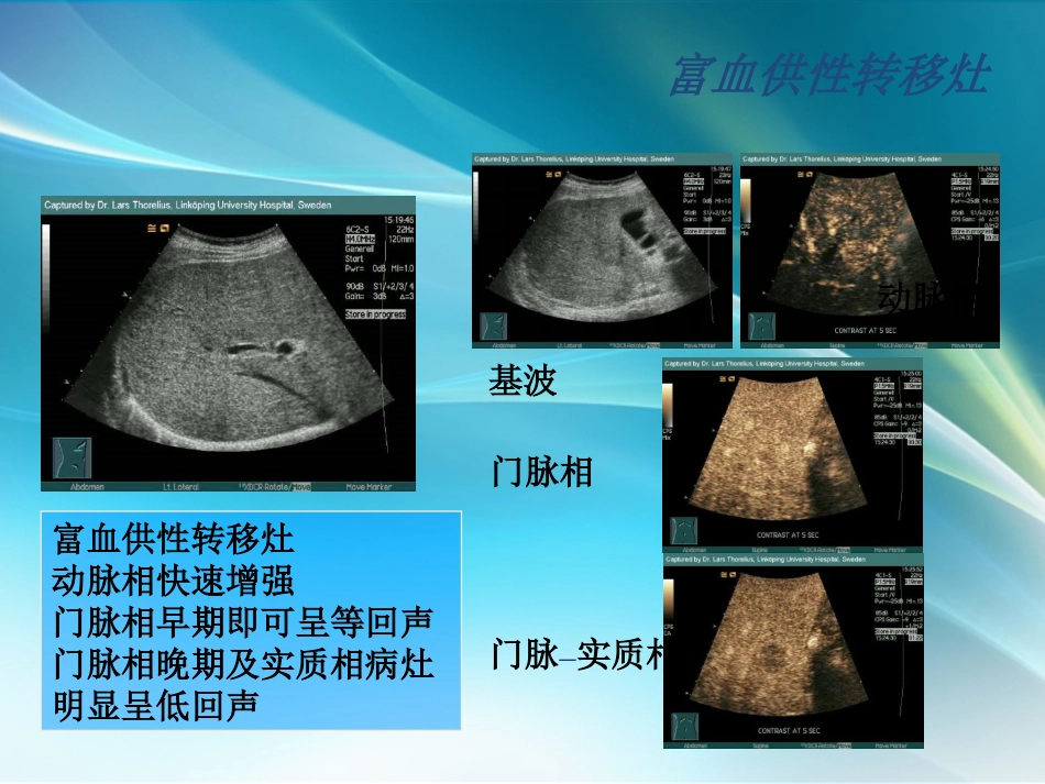 肝癌超声造影_第8页