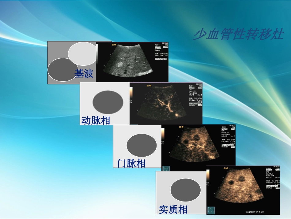 肝癌超声造影_第9页