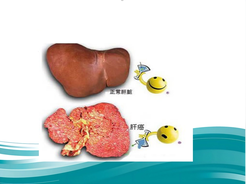 肝癌的治疗与护理_第4页