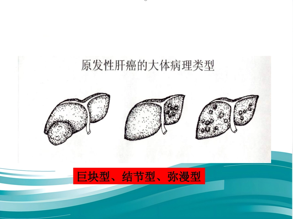 肝癌的治疗与护理_第9页