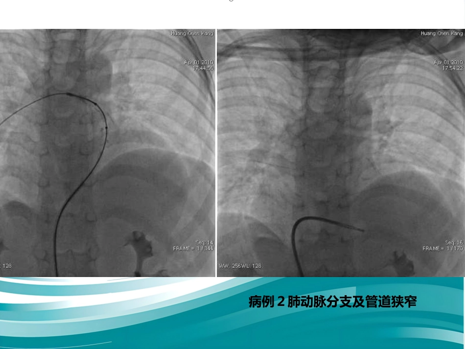 肺动脉分支狭窄的介入治疗_第11页
