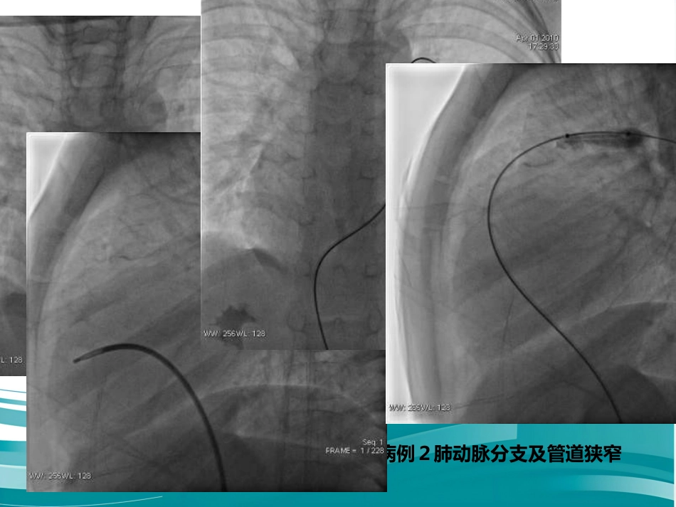 肺动脉分支狭窄的介入治疗_第9页