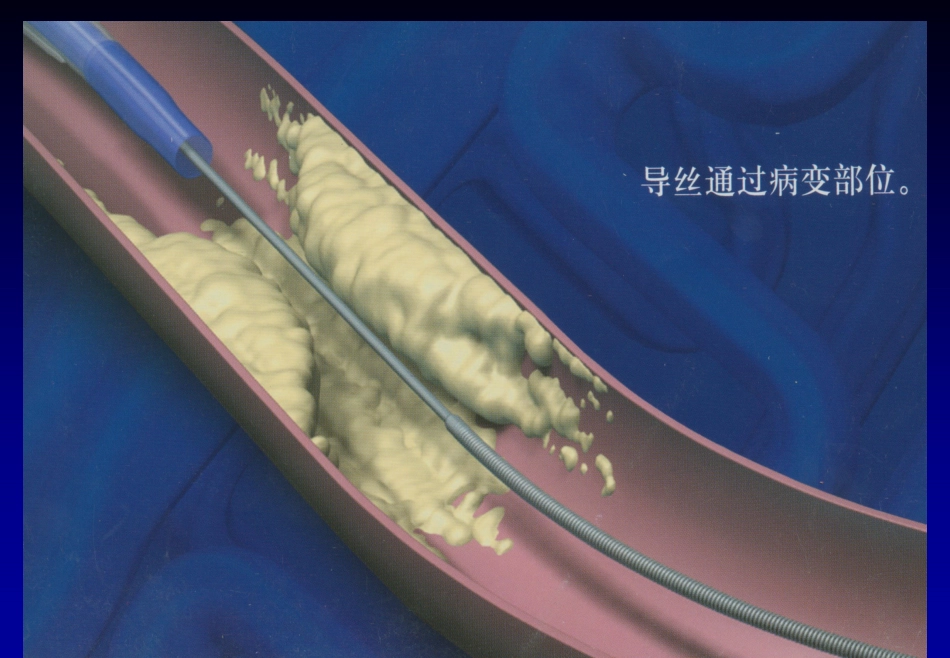 《心脏介入治疗》ppt课件_第10页