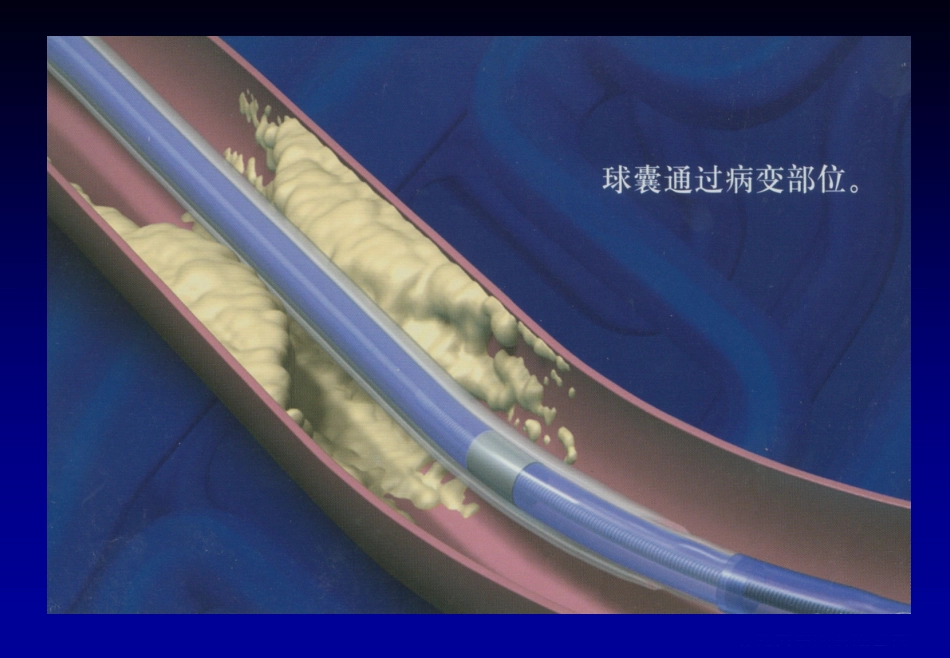 《心脏介入治疗》ppt课件_第11页