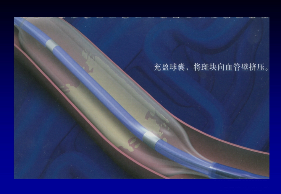 《心脏介入治疗》ppt课件_第12页