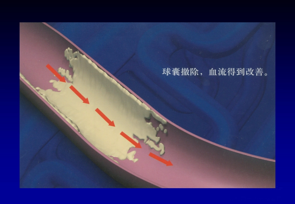 《心脏介入治疗》ppt课件_第13页