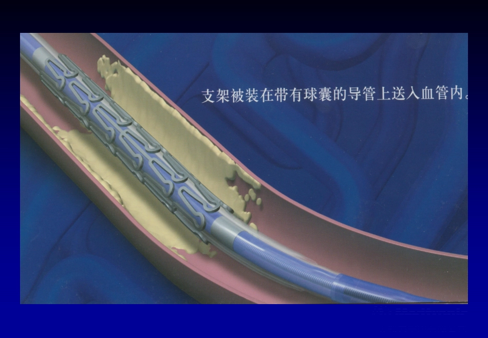 《心脏介入治疗》ppt课件_第14页