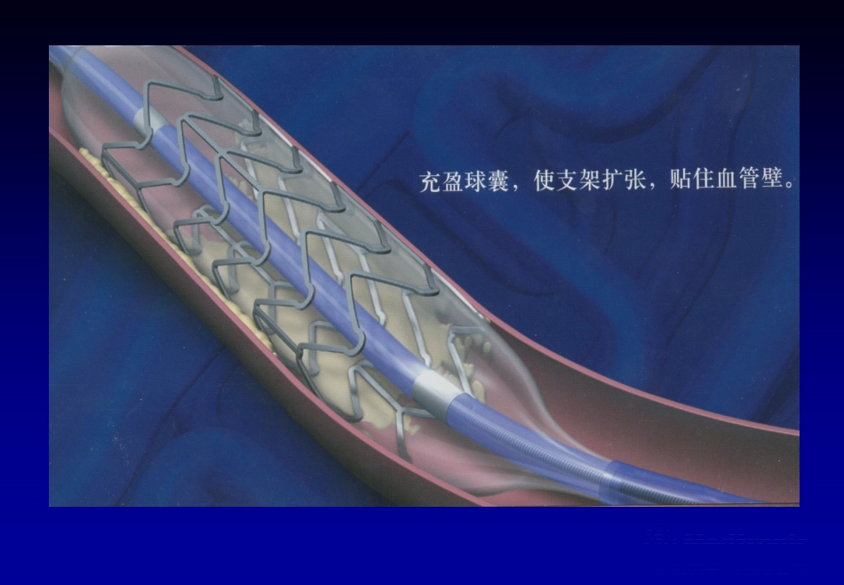 《心脏介入治疗》ppt课件_第15页